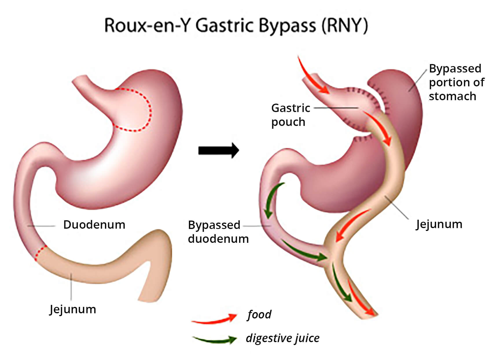 Roux en Y gastric bypass | Obesity Surgery WA Perth & Murdoch