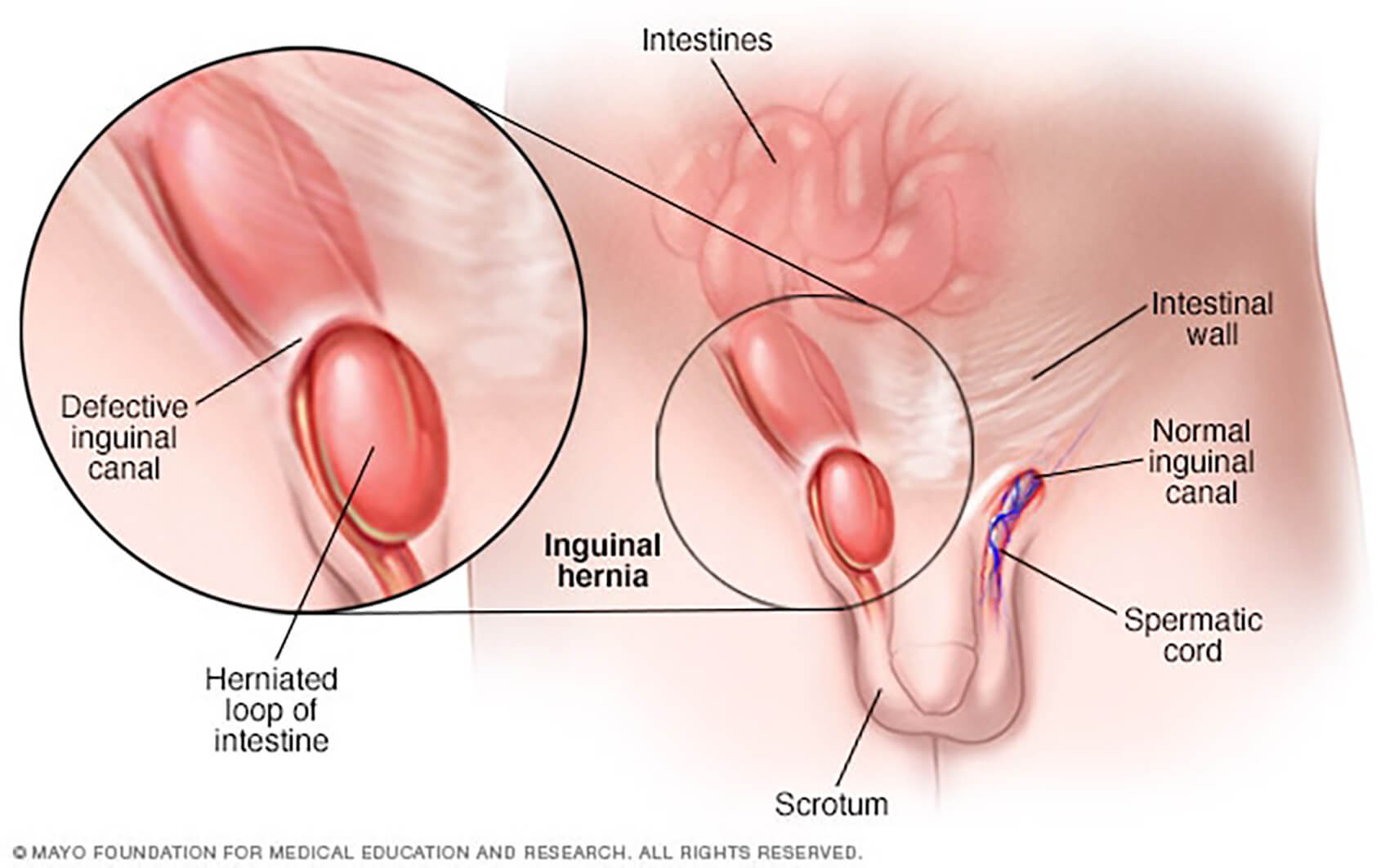 Inguinal hernia (male)