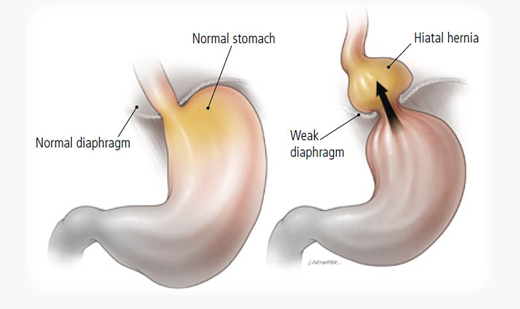 Hiatus hernia - Obesity surgery WA