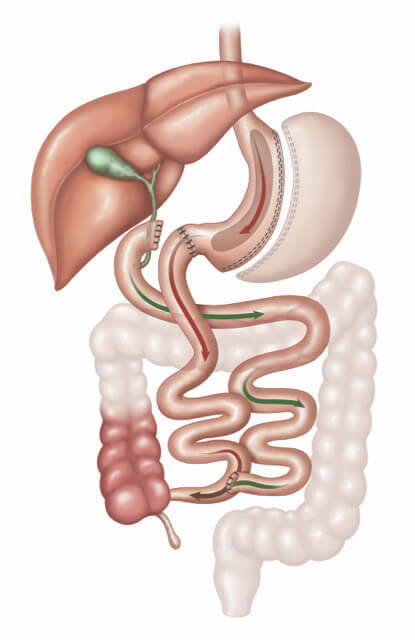 Biliopancreatic diversion surgery