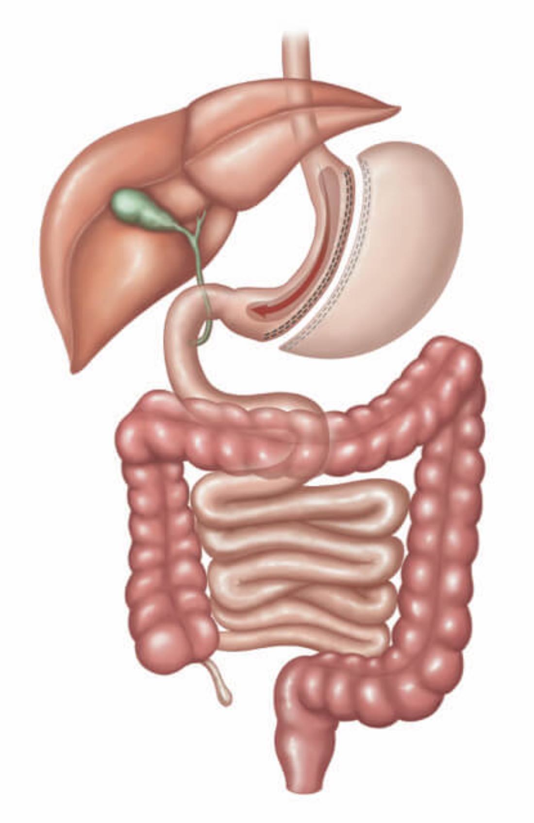 gastric sleeve Perth